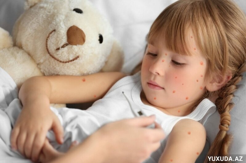 Yuxuda qızılca olmaq